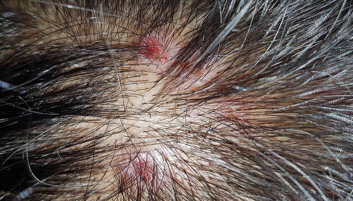 Hard Water and Scalp Folliculitis: Why the Itchy Bumps Appear and What Helps