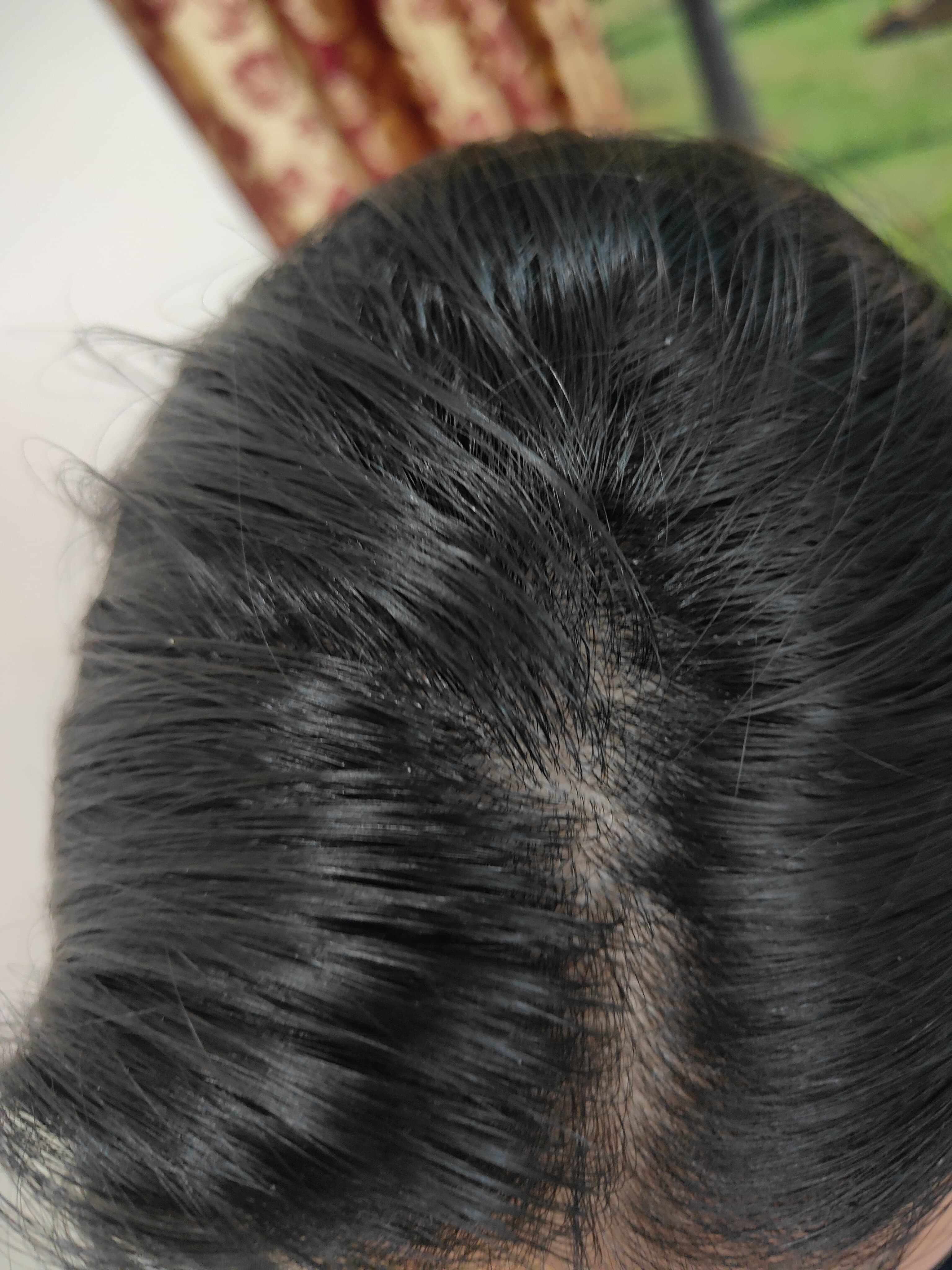 Scalp after using deSal